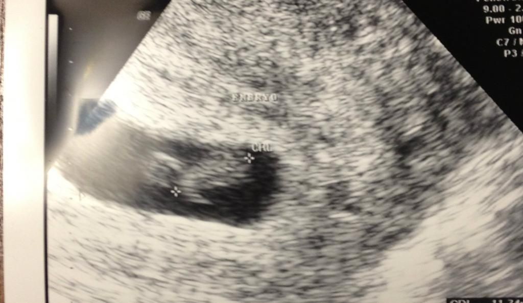 Yolk Sac Location predict gender? | BabyCenter