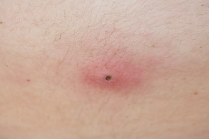 brown recluse spider bite blister. rown recluse spider bite