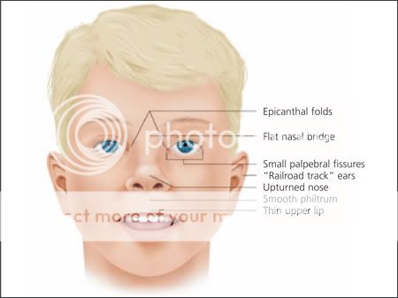 Recognizing Fetal Alcohol Syndrome/Fetal Alcohol Effects - BabyGaga